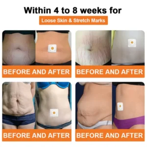 Cvreoz® Bee Venom Lymphatic Drainage Slimming Patch
