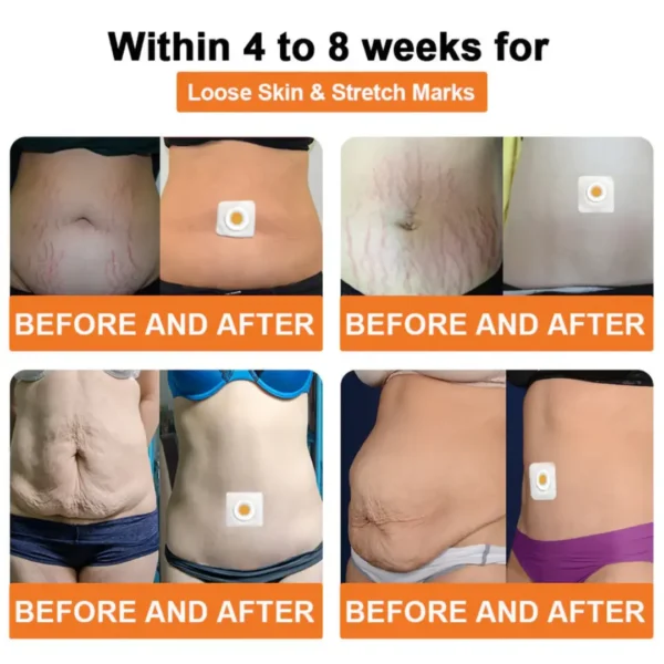 Cvreoz® Bee Venom Lymphatic Drainage Slimming Patch