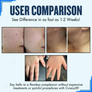 Cvreoz® Moles & Warts Removing Skin Tag Patch