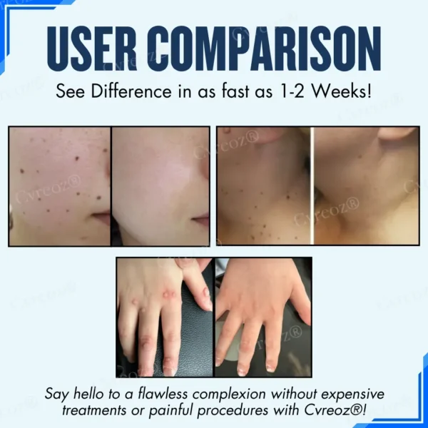Cvreoz® Moles & Warts Removing Skin Tag Patch