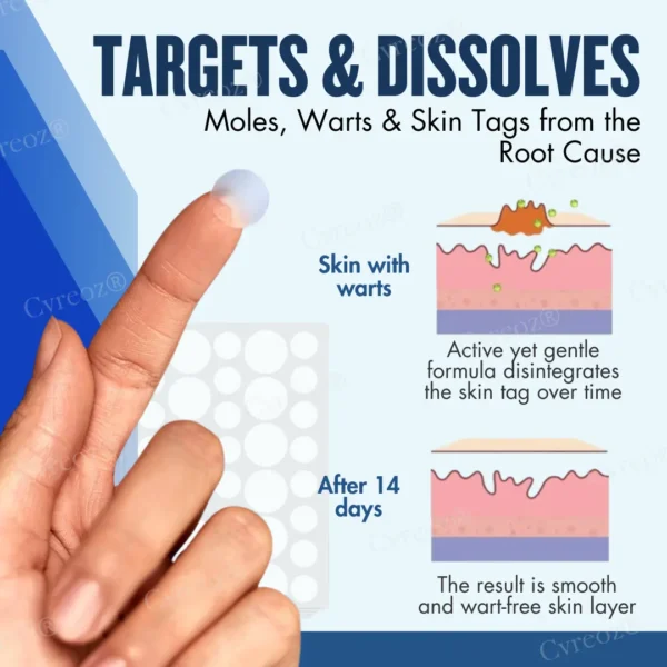 Cvreoz® Moles & Warts Removing Skin Tag Patch