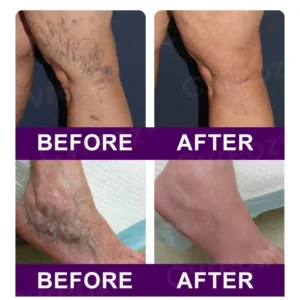Cvreoz® Polidocanol Nano Patches for Varicose Veins