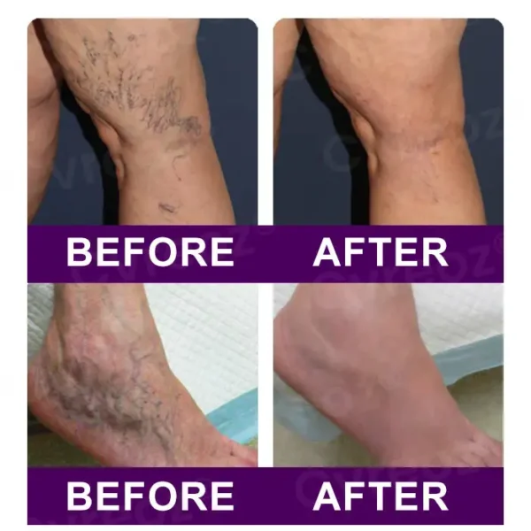 Cvreoz® Polidocanol Nano Patches for Varicose Veins