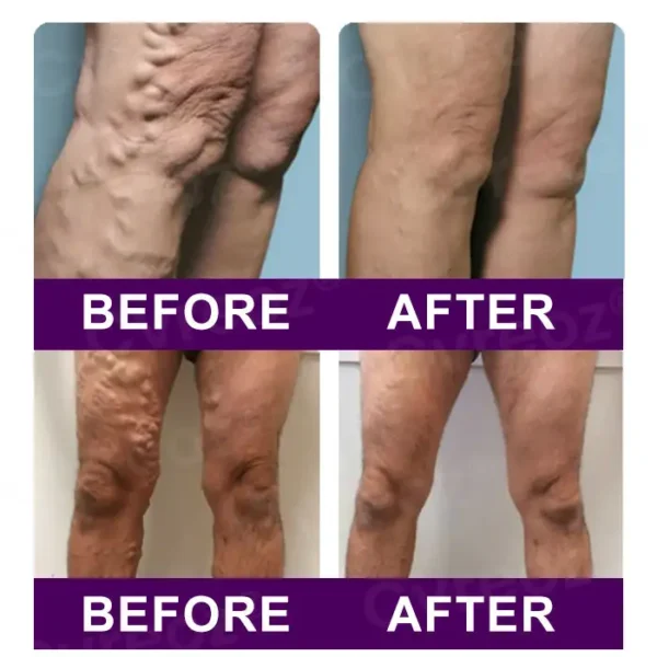 Cvreoz® Polidocanol Nano Patches for Varicose Veins