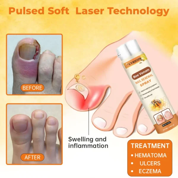 Cvreoz®Bee Venom Nail Renewal Spray